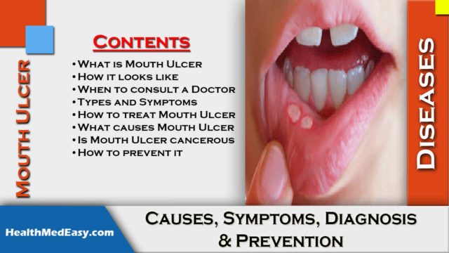 Mouth Ulcer Causes Symptoms Diagnosis Prevention Healthmedeasy 3724