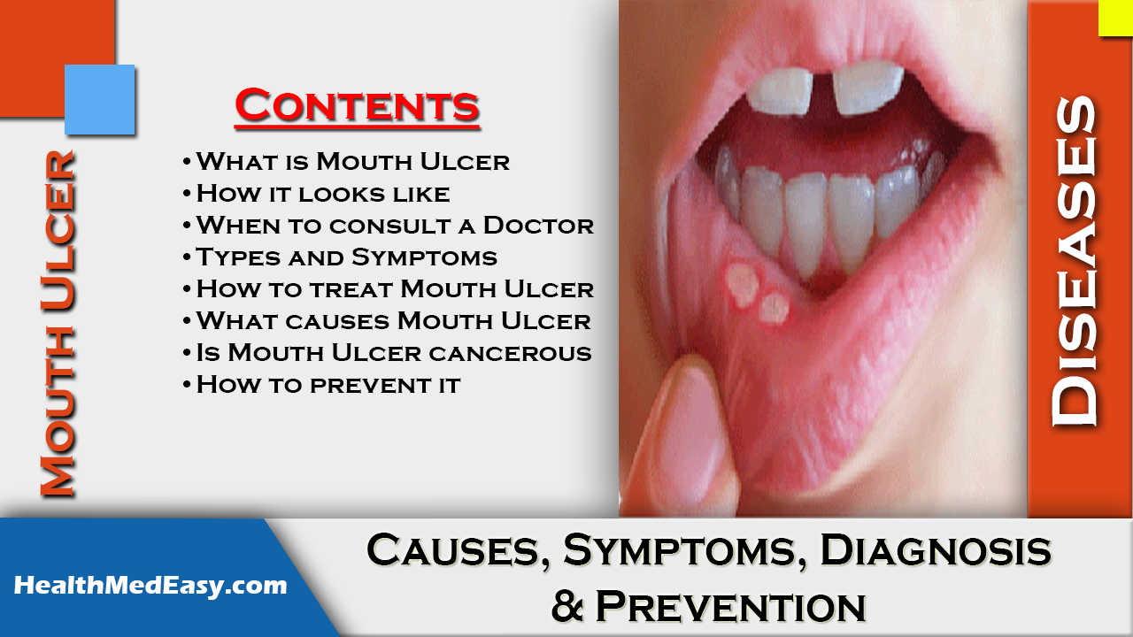 What Systemic Diseases Cause Mouth Ulcers