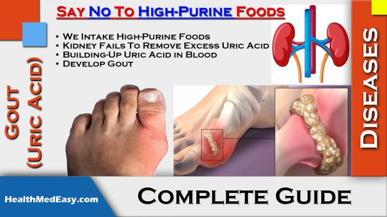 Gout And Uric Acid Symptoms Treatments Side Effects Health Medicine 2092