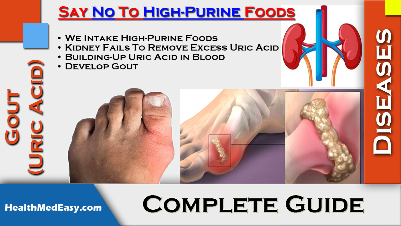 Gout Uric Acid Symptoms Treatments Side Effects HealthMedEasy 